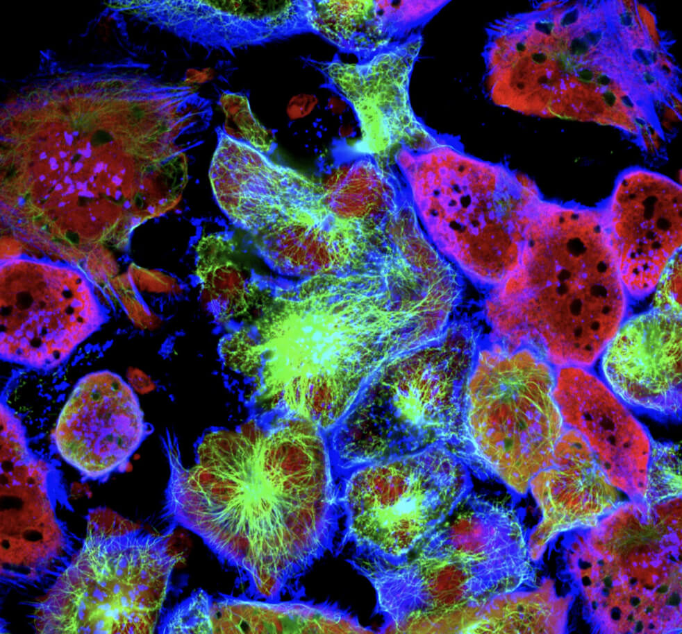Tumor cells under a microscope labeled with fluorescent molecules.